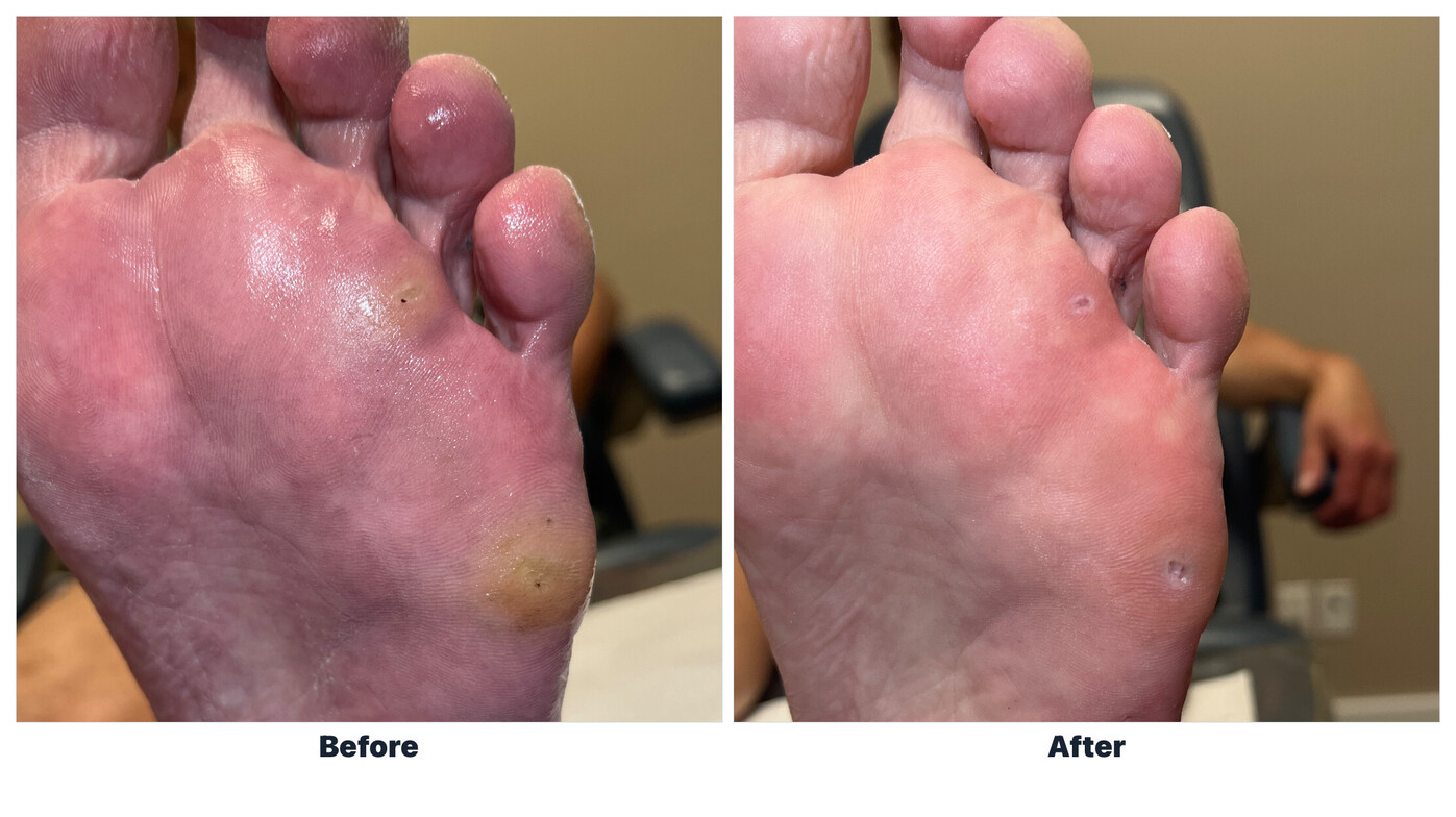 Side-by-side clinical photographs of plantar corns before and after professional reduction, with identifying details removed.