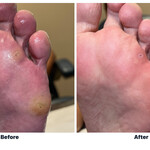 Side-by-side clinical photographs of plantar corns before and after professional reduction, with identifying details removed.